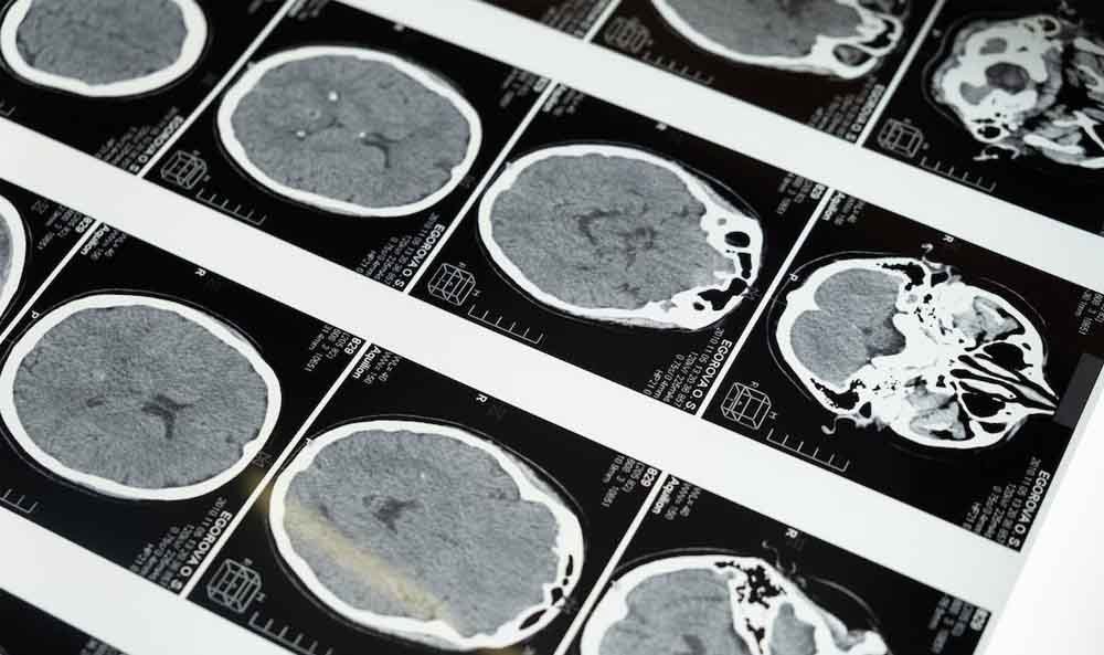 Beyin İmaging Teknolojialerinin Klinik Uygulamaları: Gelecekteki Olası Etkileri